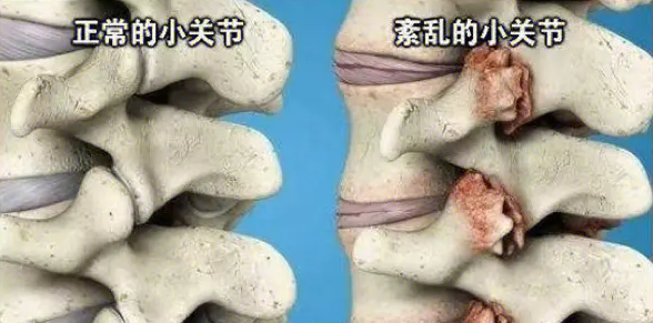 邵陽創(chuàng)傷骨科,邵陽風濕病區(qū),邵陽骨質(zhì)增生,邵陽關節(jié)病區(qū),邵陽頸椎病區(qū)